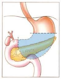 Dieetadvies na een gedeeltelijke maagresectie De maag is een onderdeel van het spijsverteringskanaal.