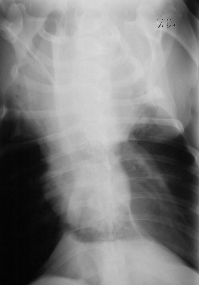 DV-opname: liquothorax, verplaatste trachea