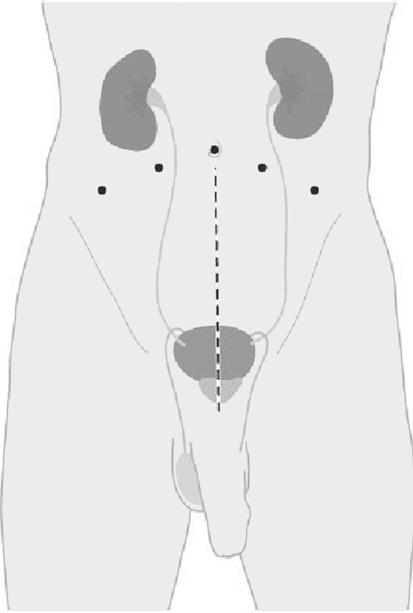 De behandeling De operatie, het verwijderen van de prostaat, wordt via een kijkoperatie uitgevoerd met behulp van een operatierobot (DaVinci ).