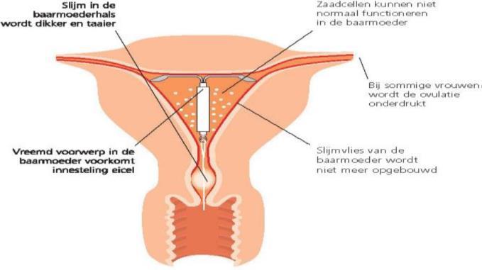 Het hormoonspiraaltje (Mirena) Werking Het geeft progestageen af. Hierdoor wordt het slijm van de baarmoedermond minder toegankelijk voor zaadcellen.