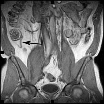 Proefschriften In hoofdstuk 8 presenteren we het eerste artikel van de MRI-bevindingen van appendagitis epiploica bij twee patiënten.