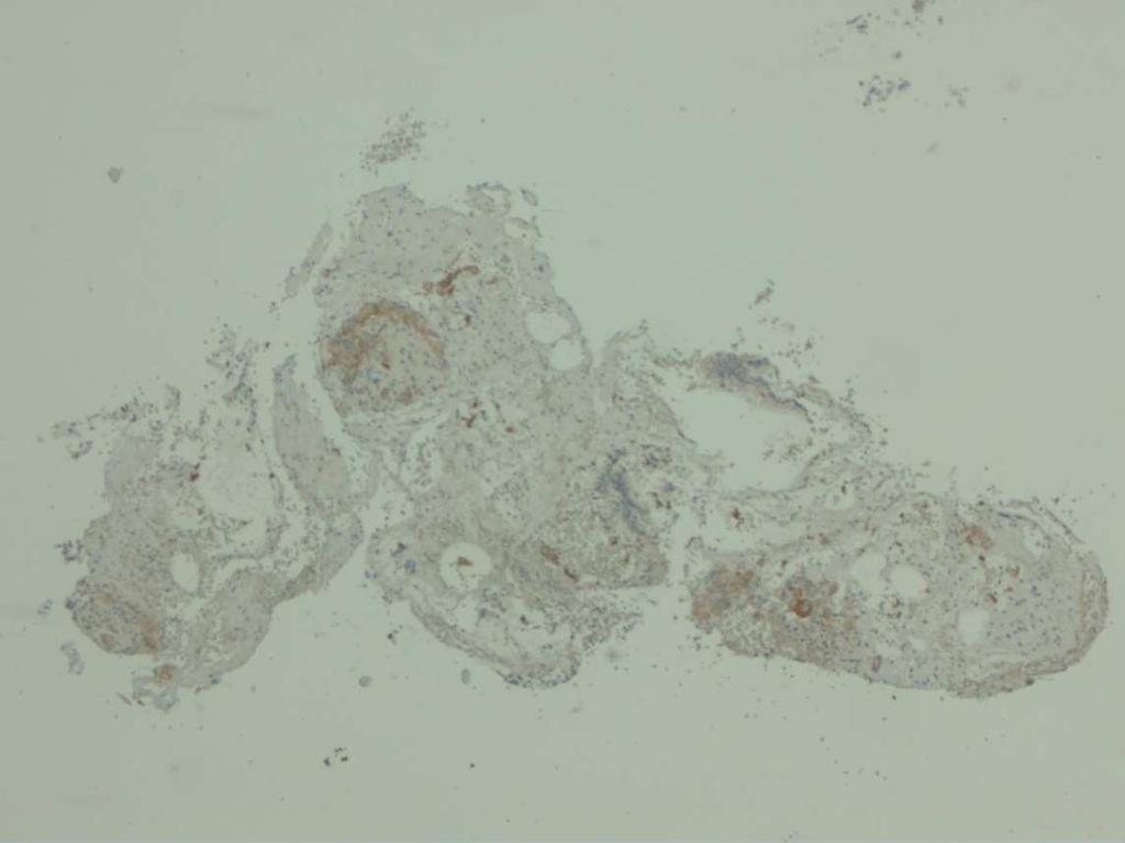 7% AC) > crizotinib HER2-mutatie (2% AC) > herceptin