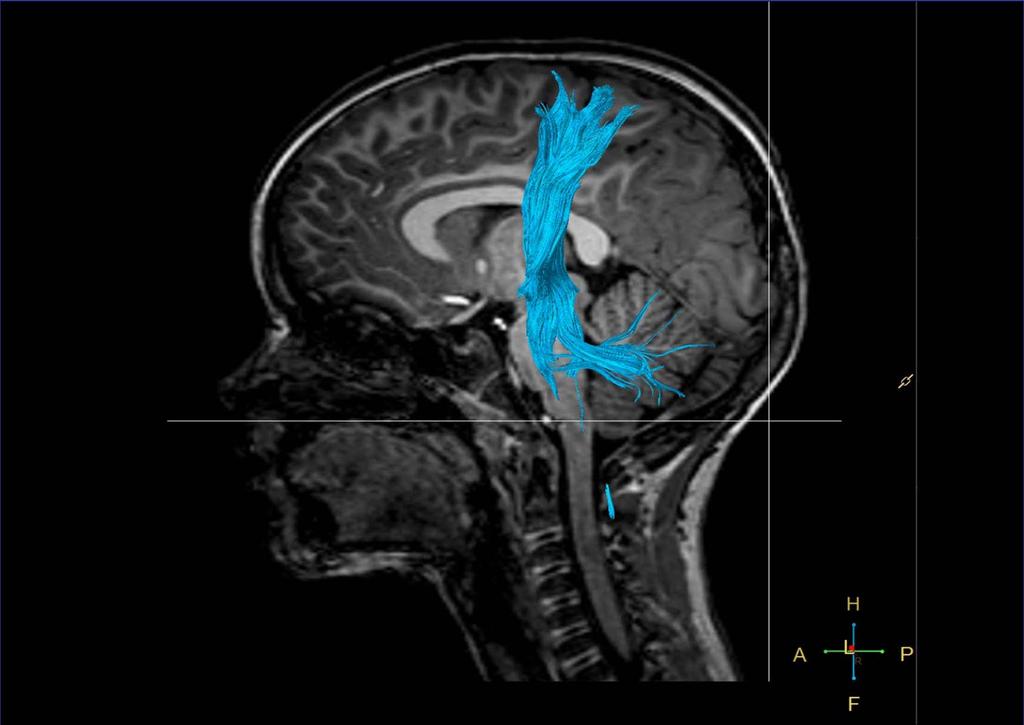 DTI Preoperatieve