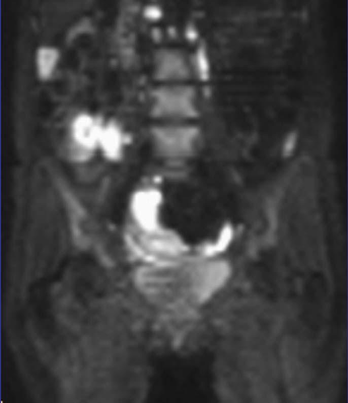 MRI can accurately predict the peritoneal cancer index