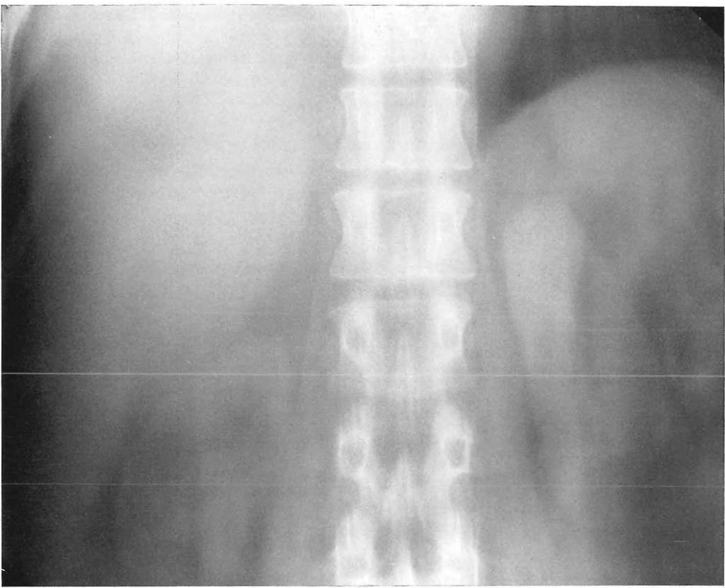 Figuur 40 Patiënte B. S., 57 jaar oud, was van de trap gevallen. Zij klaagde over pijn rechts onder in de thorax en rechts lumbaal. In de urine waren 6 erythrocyten p/g.