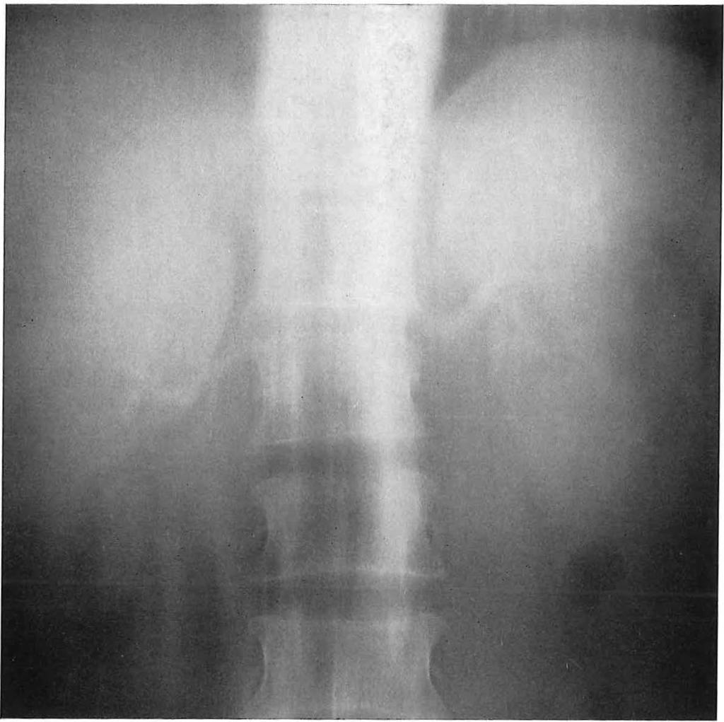 Figuur 2 gegeven, niet meer te ademen. Wanneer de patiënt hieraan gevolg heeft gegeven zijn weer enige seconden verlopen, zodat de simultaan tomografie op 18 seconden kan plaats vinden (fig. 2).