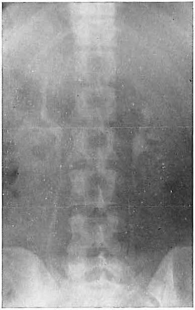 I 6 seconden na injectie. Blanco opname. Il 18 seconden na injectie. Vasculair nephrogram.