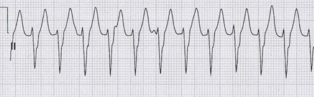 Ventriculaire tachycardie Zeer zeldzaam Brede QRS complexen