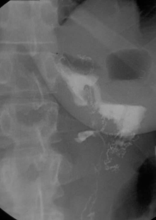 Vroege post operatieve Complicaties Bloeding Staple line Intra abdominaal Lekkage / perforatie (1.