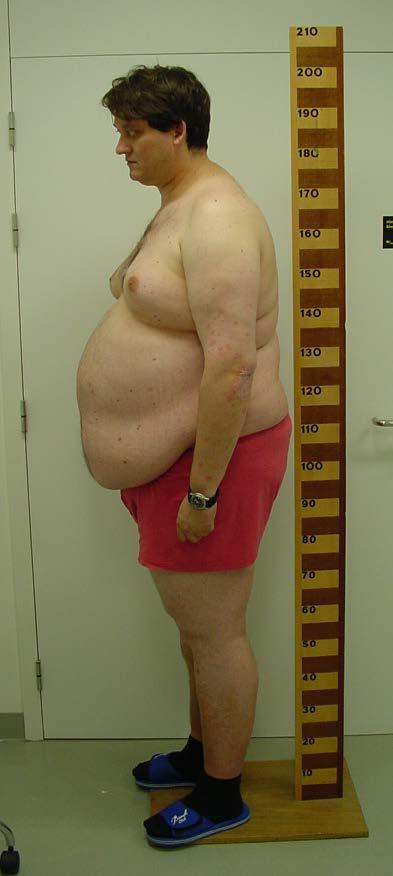 Definitie Obesitas (BMI>30 kg/m 2 ) Europa 12-15% USA >30% Morbide Obesitas BMI >