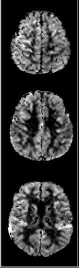 hersenen DMD