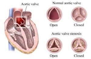 Kleplijden, aorta Valvulaire