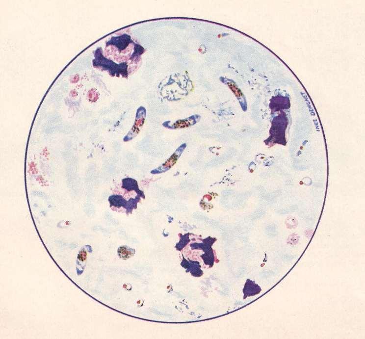 P. falciparum dikke druppel ringvormige trofozoieten gametocyten