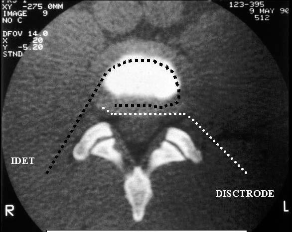 RF Discogenic pain Grade of recommendation : 6 RCT ramus communicans : Oh 2004 2B+ disc : Barendse 2001 (-), Ercelen