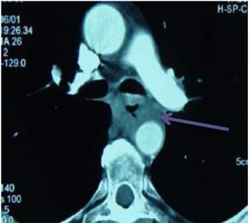 HK: Geen meerwaarde bij T4b tumoren Bronchoscopie Tracheale invasie Oesotracheale fistel CT-scan