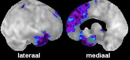 Hyperoraliteit en verandering voedingspatroon Sociaal cognitief en executief fie Taalvariant taalvermogen: spraakproductie, vinding,