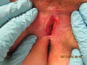 clitoris. behandeling verbetering geeft, kan de behandeling worden afgebouwd naar eenmaal daags, gedurende drie tot vijf aaneengesloten dagen per week. Tacrolimuszalf is een goed alternatief.