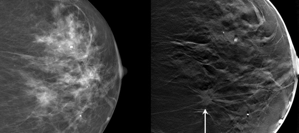 Tomosynthese: 3D mammogram Verhoogt de