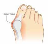 Qu il s agisse de chevauchement d orteil, d hallux valgus, d orteil en griffe ou bien de syndrome du pied diabétique.