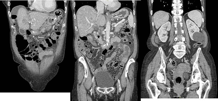 pagina 12 van 19 Dit is een (i) CT abdomen (ii) echo abdomen (iii) MRI abdomen, het betreft een (i) axiale (ii) coronale (iii) sagittale doorsnede, bij een patiënte met een massavormend