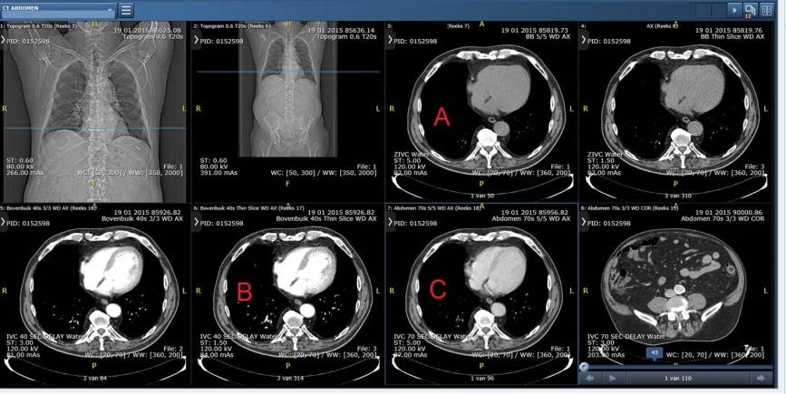 pagina 5 van 19 corpus gastro-oesofageale overgang IF choice c. is selected o of bc Bekijk de afbeelding. In welke contrastfase is de CT abdomen gemaakt?