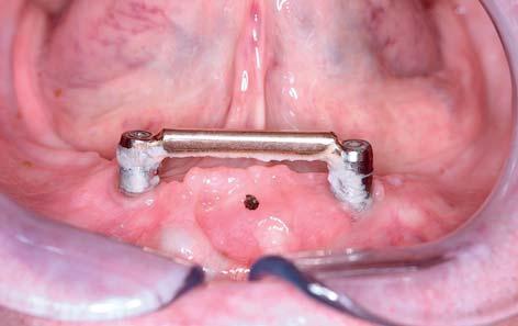 onderzoek opgezet met als doel inzicht te krijgen in hoe 75-plussers met een over kappingsprothese op implantaten in de onderkaak functio neren en welke peri-implantaire zorg zij nodig hebben.
