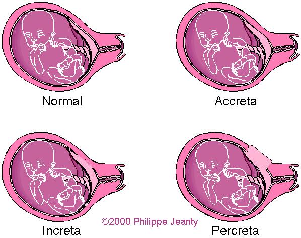 Abnormaal adhesieve placenta Accreta: afwezigheid van decidua