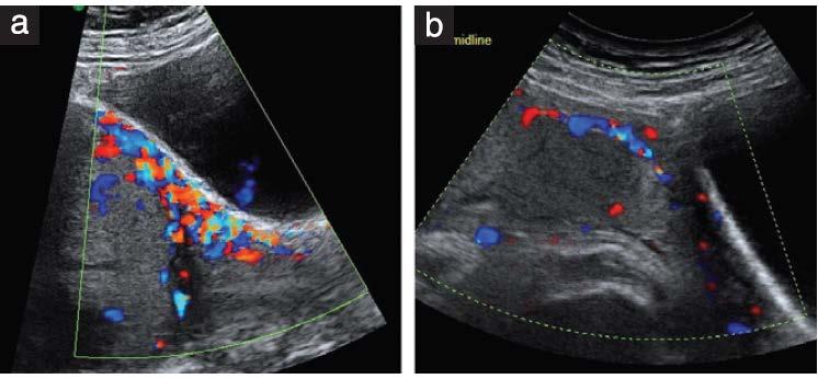 Abnormaal adhesieve placenta