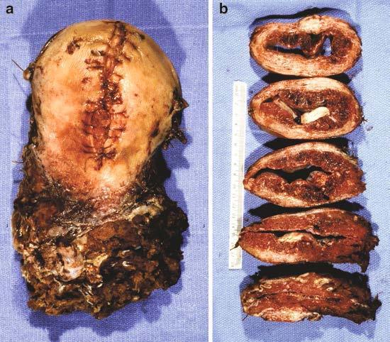 Abnormaal adhesieve placenta Beleid partus - Multidisciplinair beleid (anesthesioloog, gynaecoloog (- oncoloog), perinatoloog,