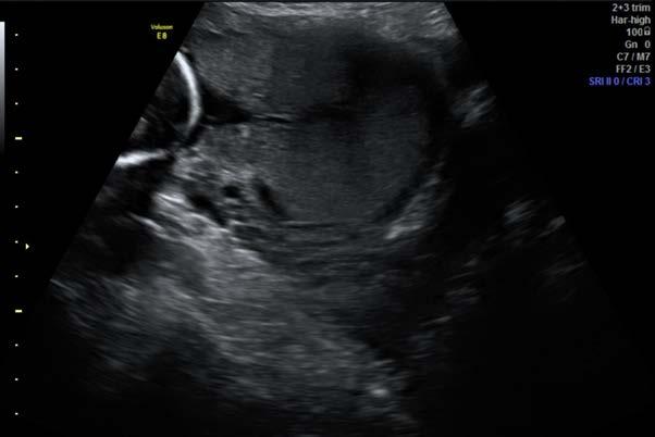 Abnormaal adhesieve placenta Placenta laag anterior, over SC litteken, dunne