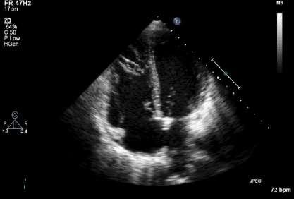 Identificatie pulmonaal venen in apicale 4k opname Welke pulmonary veins zijn