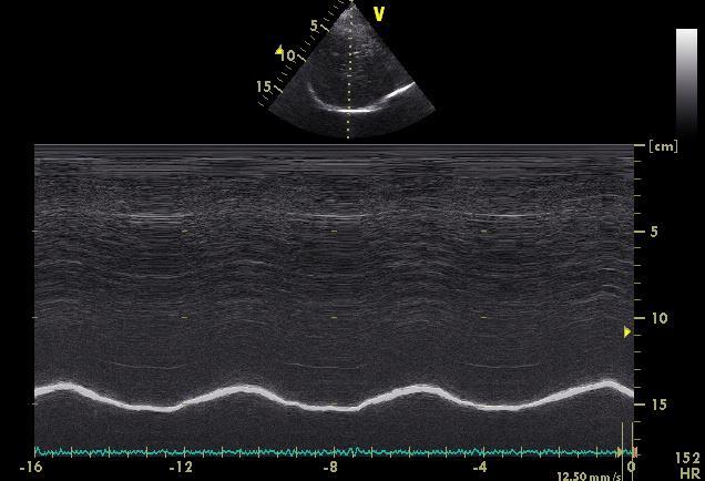 Echografie diafragma B-mode