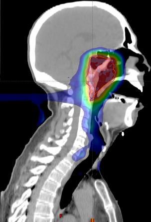 PT for Nasopharynx/Oropharynx Ca 50%+ reduction in feeding tubes ProtonTherapy