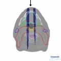 NTCP Based Patient Selection Photons Protons 9 NVRO