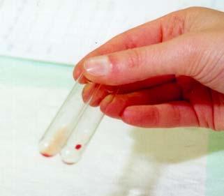 IgM antistoffen Zijn ze gericht tegen bloedgroep met foetale
