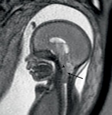 Contraststoffen Gadolinium Teratogeen Skelet malformaties Iodide Foetale schildklierfunctie Tumormerkers Niet diagnostisch!