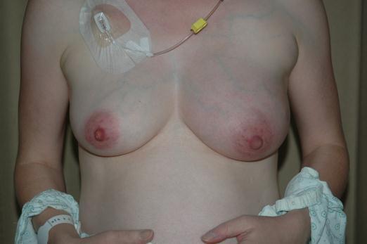 Diagnose van borstkanker tijdens de zwangerschap Voorgeschiedenis