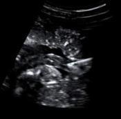 Results of transplacental transfer of chemotherapeutic agents in a pregnant baboon model, based on simultaneously collected maternal and foetal plasma samples. Van Calsteren et al.