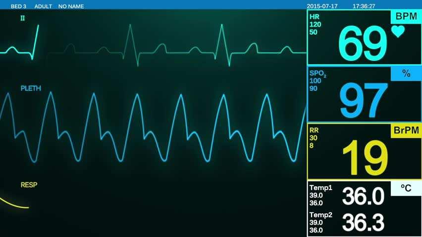 Achtergrond Verschillende manieren van registreren van een ECG Monitor ECG - Wisselende manier van electrodeplaatsing - Variabele ECG vorm