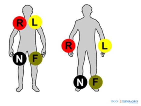 ECG maken 4 lidmaatelectroden Rood: rechterarm Geel: linkerarm Groen: linkerbeen Zwart: rechterbeen ECG maken 6 borstwandelectroden V1: 4e intercostaalruimte, rechts van sternum V2: 4e