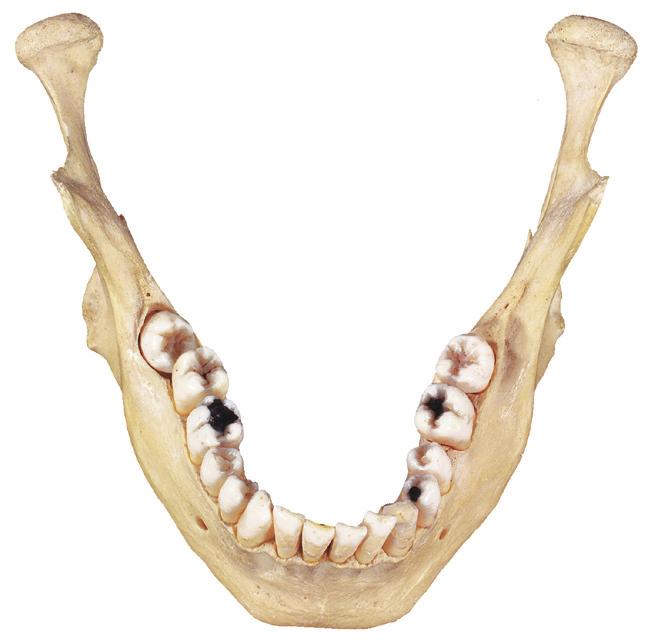 mylohyoidea Basis mandibulae a Aanzicht achter-onder Fossa digastrica Torus mandibularis Spina mentalis inferior Spina mentalis superior Fovea submandibularis Fovea sublingualis