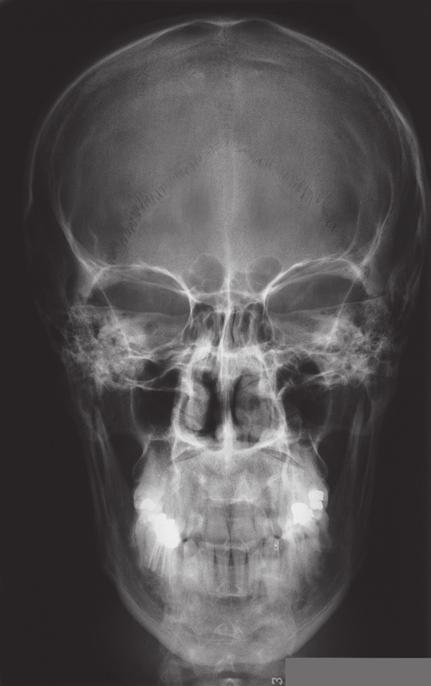 Schedel: röntgenfoto s 2.28a,b Röntgenfoto s van het hoofd van een vrouw (34 jaar).