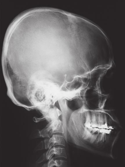 maxillaris Concha nasalis inferior Spina nasalis anterior Ramus mandibulae Sinus frontalis Ala minor van het os sphenoidale Fissura orbitalis superior Cellulae ethmoidales Cellulae mastoideae