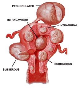 Take home message Subfertiliteit en myomen Submuceuze myomen Beinvloeden fertiliteitskansen Behandelen - TCRM Intramurale intramurale myomen Beinvloeden fertiliteitskansen Behandelen? RCT nodig!