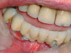 Gevolgen van tandproblemen Cariës Terugtrekken tandvlees, vooral