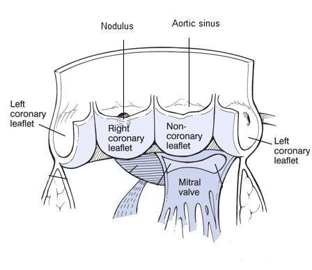 INLEIDING Verder beschikt de klep over 3 sinussen van Valsalva. Deze worden gedefinieerd als de zakvormige ruimte tussen de rand van elk klepblad en de aortawand.
