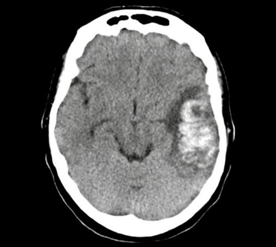 Cerebrale veneuze trombose S.M.