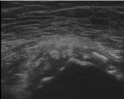 gluteus medius http://www.ultrasoundcases.