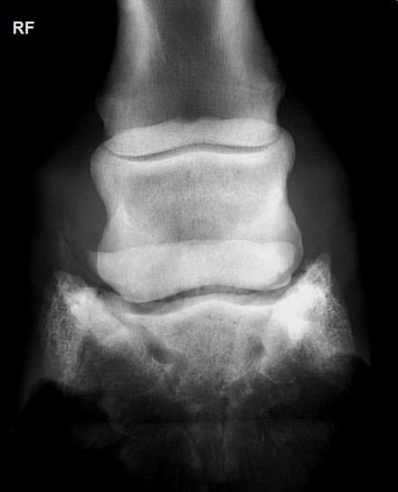 Figuur 4: lateromediale röntgenopname van de linker voet.