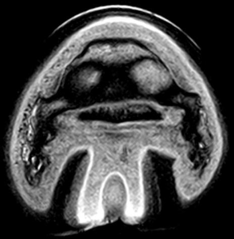 BEELDVORMING EN HISTOPATHOLOGIE VAN PODOTROCHLEOSE BIJ HET PAARD: EEN CASUS Figuur 18: MRI beeld van de linker voet,